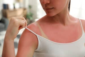 Picture of a woman with sun poisoning looking at her sunburned shoulder.