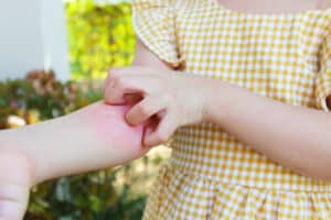 Picture of a young girl scratching a bug bite on her forearm.
